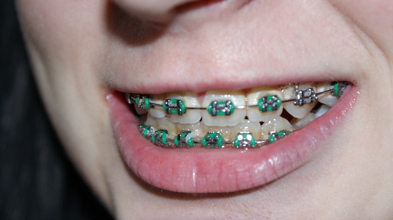 Types of braces