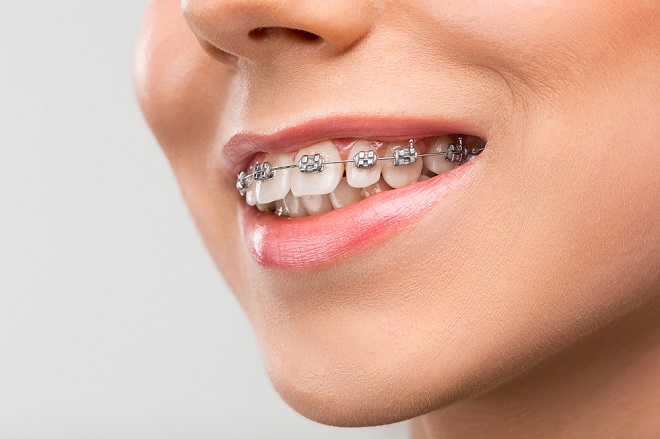 affordable braces